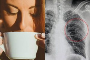 Terlalu Banyak Konsumsi Kopi Dinilai Buat Tulang Keropos